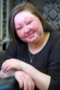 New lupus trail offers hope for Derrimut woman